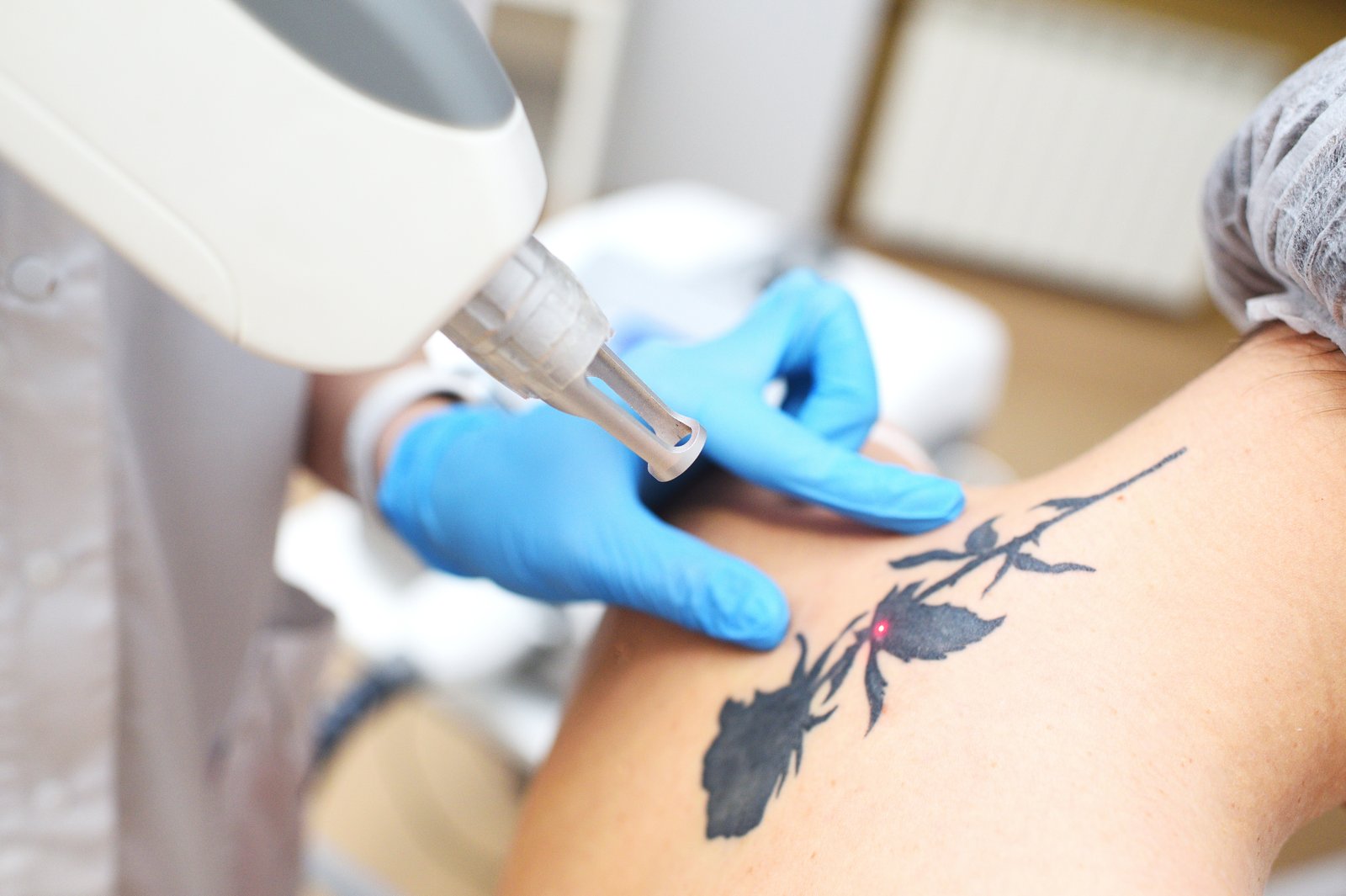 Eliminación de tatuaje 